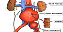 Abdominal Aortic Aneurysm (AAA)